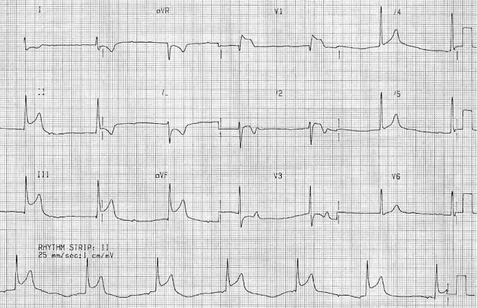 INFERIOR WALL myocardial infarction IWMI ECG Oxford 